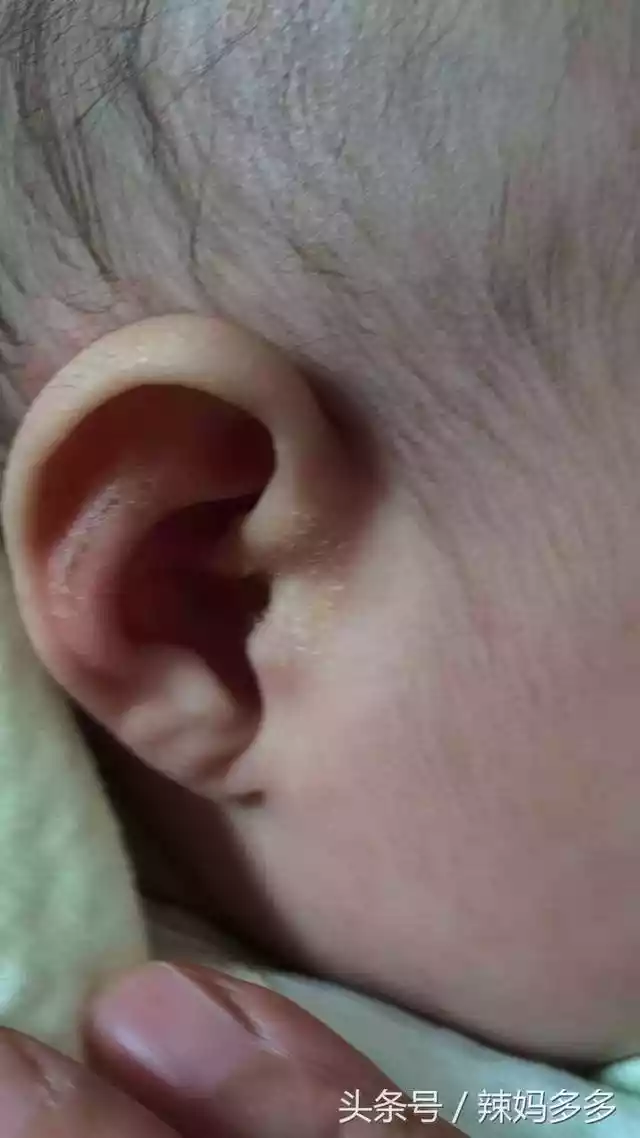 宝宝外耳道有积液和痂（婴儿外耳道湿疹会反复发作）-第2张