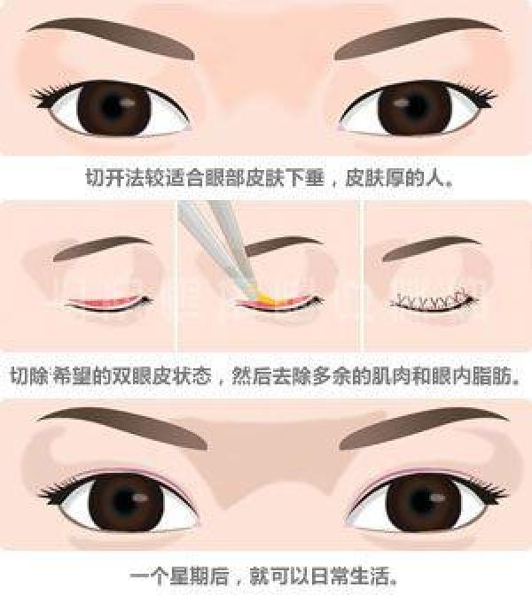 双眼皮有这4种做法（双眼皮到底怎样做才最好看呢）-第8张