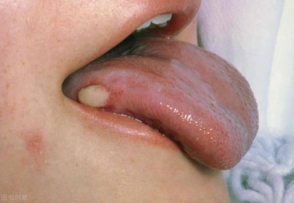 检查发现口腔癌，第一次吃槟榔就得口腔癌怎么回事-第3张
