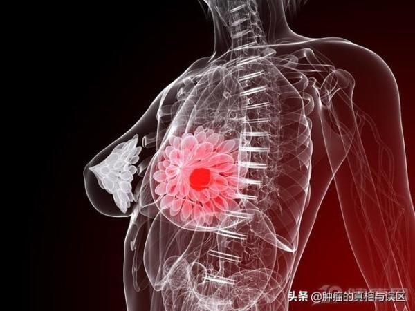 乳腺纤维瘤很难癌变，乳腺纤维瘤会有恶变的危险吗-第4张