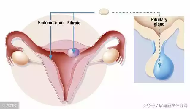 子宫肌瘤害了很多女人（女性得了子宫肌瘤要注意三件事）-第1张