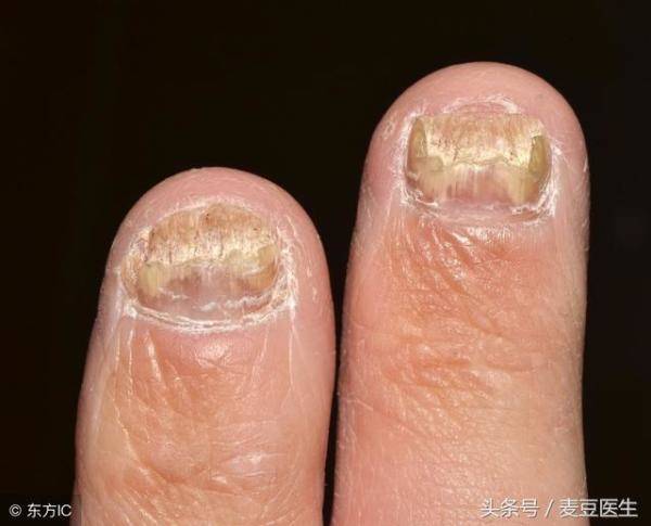 指甲苍白易裂有黑纹，指甲有黑纹并开裂-第5张