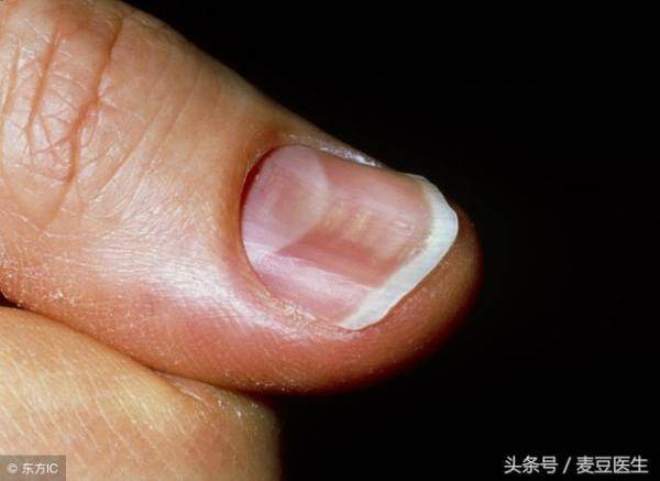 指甲苍白易裂有黑纹，指甲有黑纹并开裂-第6张