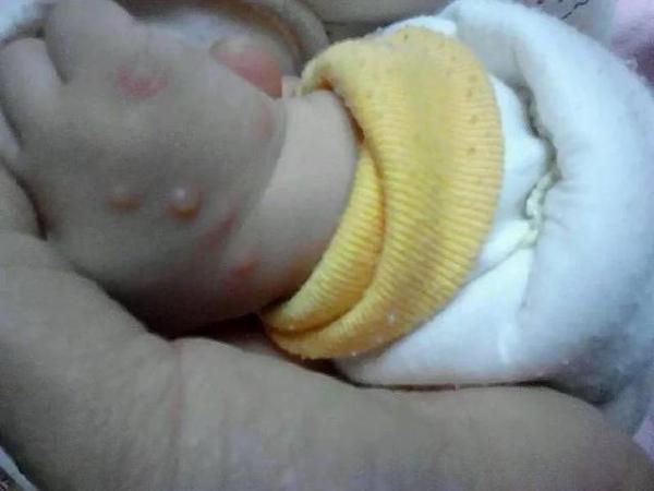 这12种宝宝常见皮肤病危害不比湿疹小（预防宝宝皮肤病的方法）-第5张