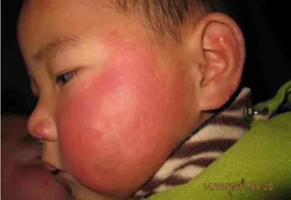 这12种宝宝常见皮肤病危害不比湿疹小（预防宝宝皮肤病的方法）-第9张
