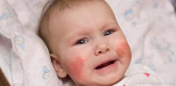 婴儿皮肤干燥湿疹反复发作（宝宝反复皮肤干起湿疹怎么预防）-第3张