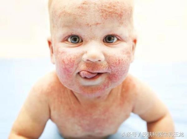婴儿皮肤干燥湿疹反复发作（宝宝反复皮肤干起湿疹怎么预防）-第4张