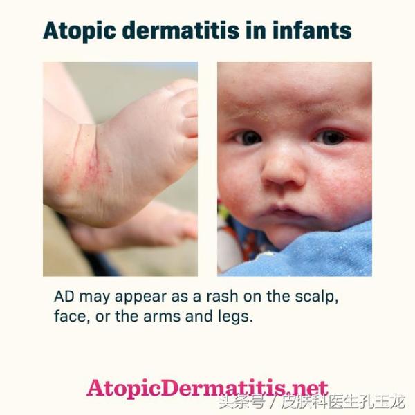 婴儿皮肤干燥湿疹反复发作（宝宝反复皮肤干起湿疹怎么预防）-第6张