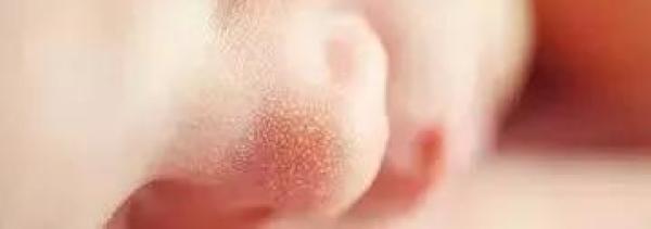 马牙粟粒疹宝宝的这28种情况是正常的（粟粒疹宝宝）-第5张