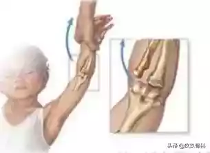 一文掌握儿童肘关节骨折（儿童肘关节骨折几天能消肿）-第42张