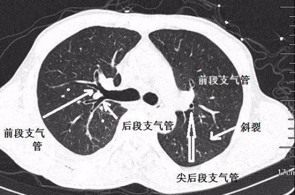 支气管CT解剖分段图谱，支气管组织的解剖结构图-第3张