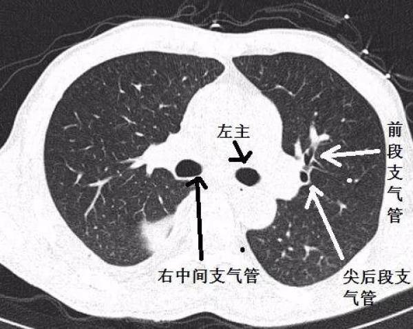支气管CT解剖分段图谱，支气管组织的解剖结构图-第5张