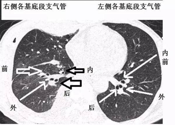 支气管CT解剖分段图谱，支气管组织的解剖结构图-第11张