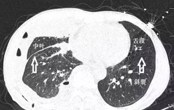 支气管CT解剖分段图谱，支气管组织的解剖结构图-第13张