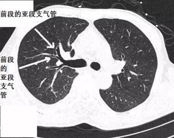 支气管CT解剖分段图谱，支气管组织的解剖结构图-第4张