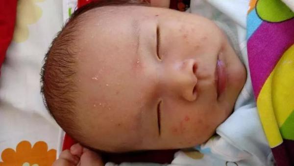 湿疹反复折磨宝宝（婴儿湿疹反反复复难治愈详细方案）-第3张