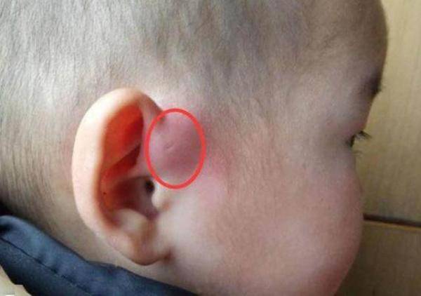 孩子生下来耳朵上就有小孔，婴儿出生耳朵后面有个小孔咋回事-第2张