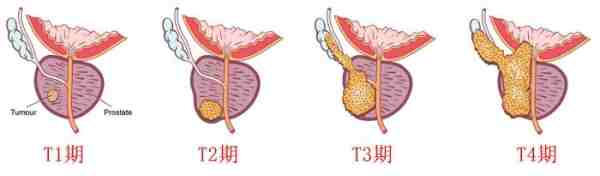 前列腺癌科普系列之三（前列腺癌的早期治疗方法有哪些）-第1张