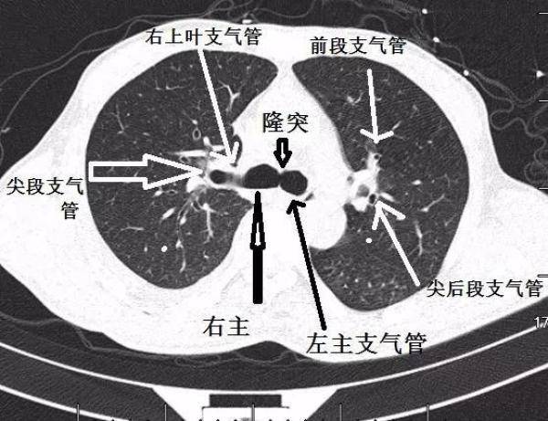 支气管CT解剖分段图谱，支气管组织的解剖结构图-第2张