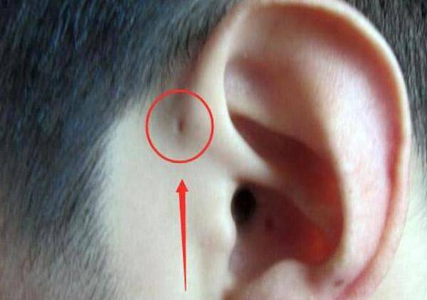 孩子生下来耳朵上就有小孔，婴儿出生耳朵后面有个小孔咋回事-第1张