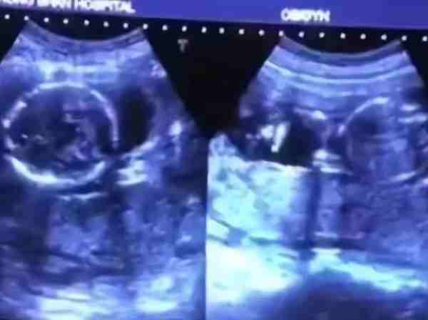 2009年湖北孕妇生下一对连体婴（女子生下双胞胎小儿子却不知所踪）-第13张