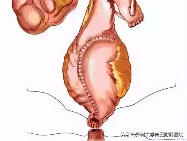 郑州大学五附院泌尿外科成功开展乙状结肠原位新膀胱尿流改道术（膀胱感染有病理管型吗）-第8张