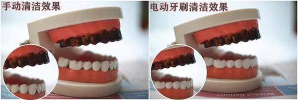 电动牙刷的正确使用方法，哪种电动牙刷对牙齿伤害小-第3张
