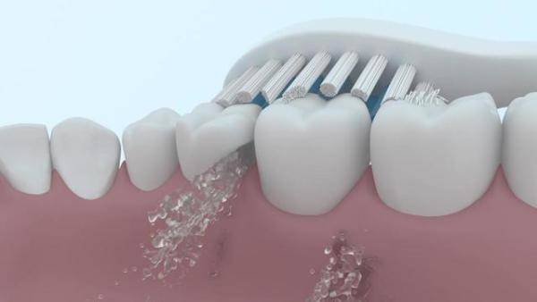 电动牙刷的正确使用方法，哪种电动牙刷对牙齿伤害小-第1张