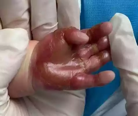 新生儿手脚真皮缺损（婴儿皮肤缺损表现）-第2张