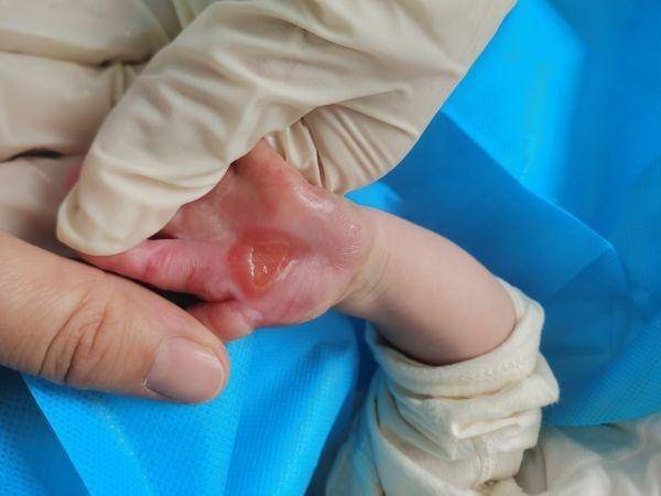 新生儿手脚真皮缺损（婴儿皮肤缺损表现）-第5张