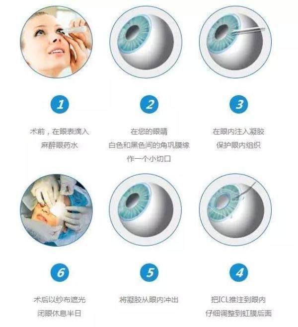 近视手术是什么，近视手术方式有几种-第4张